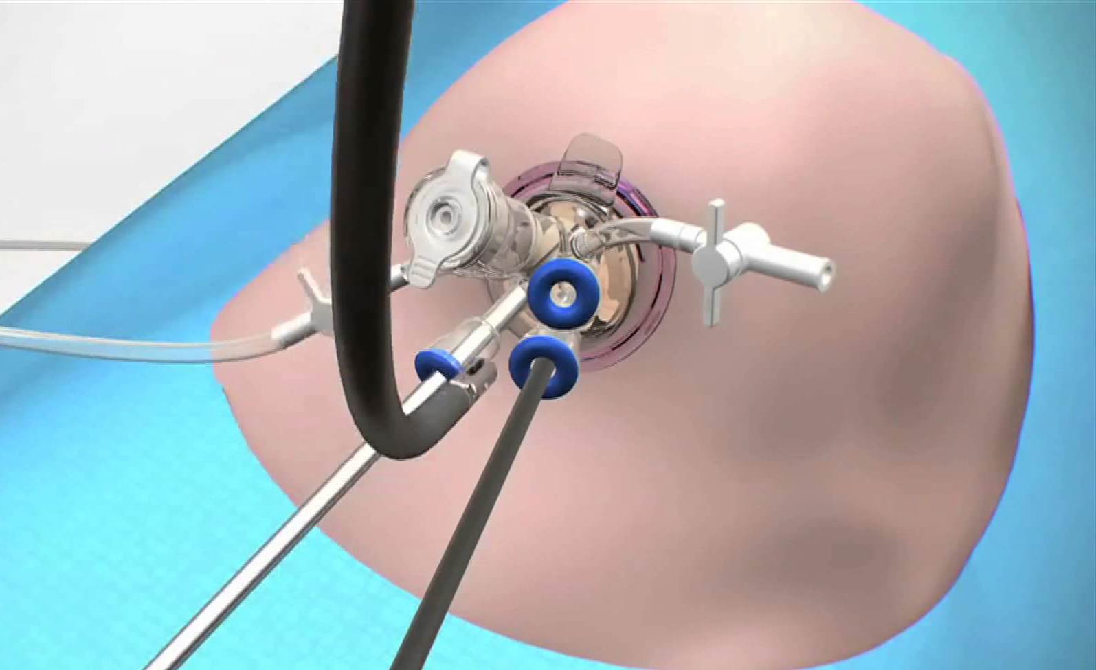 Laparoscopy in gynecology: nuances you need to know about