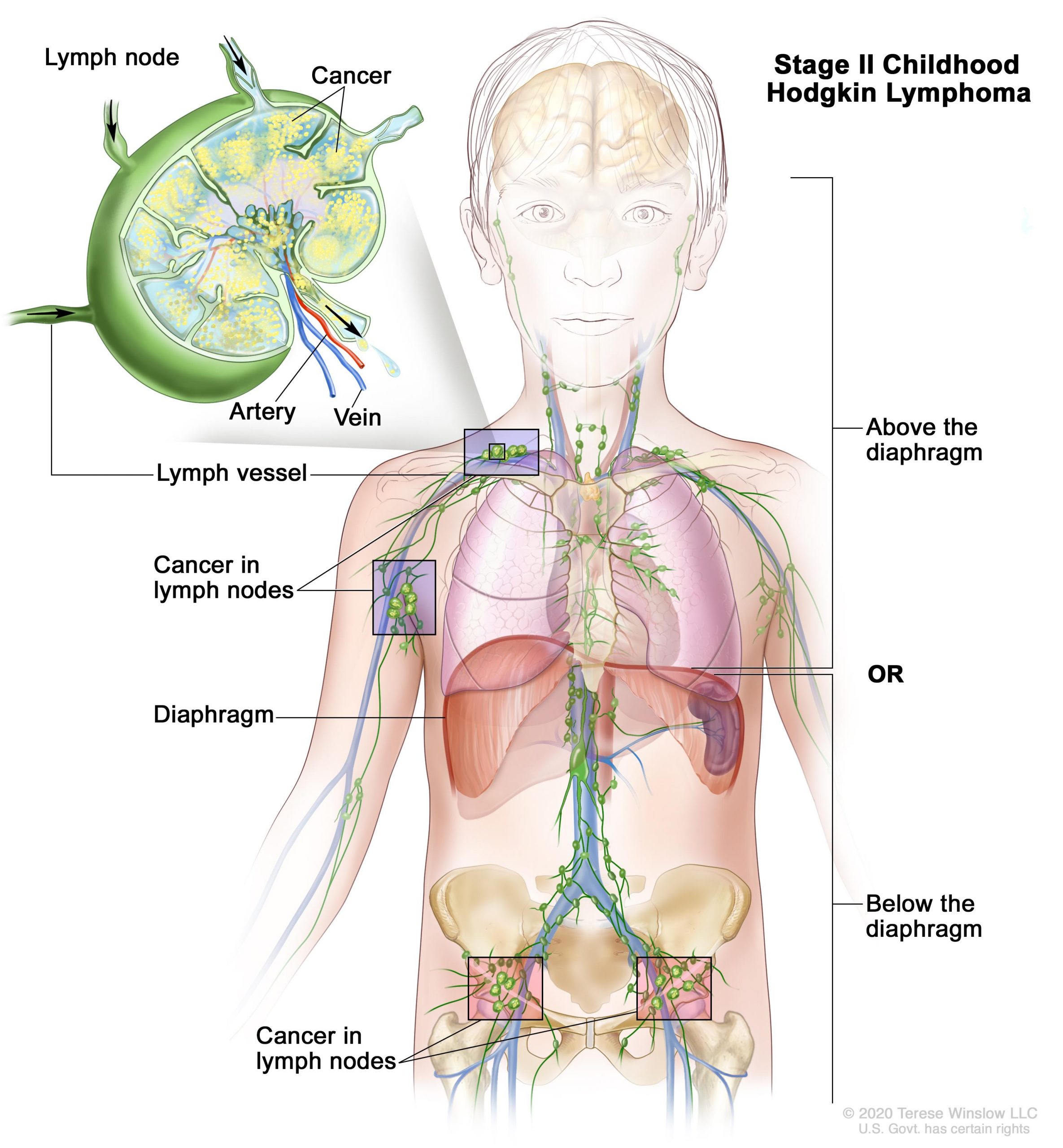 What is Hodgkin’s Lymphoma (HL)?