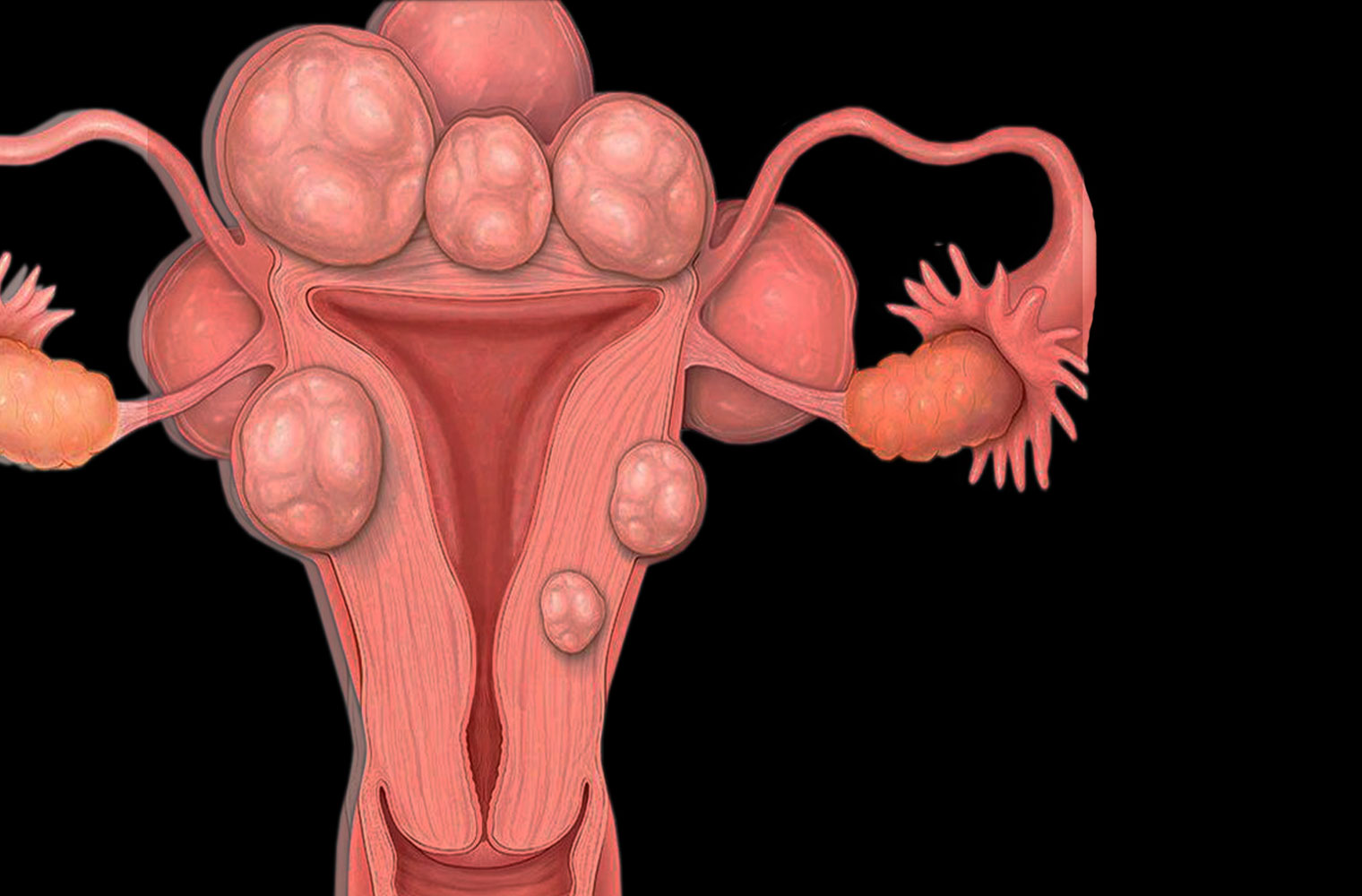 Is pregnancy possible with uterine fibroids