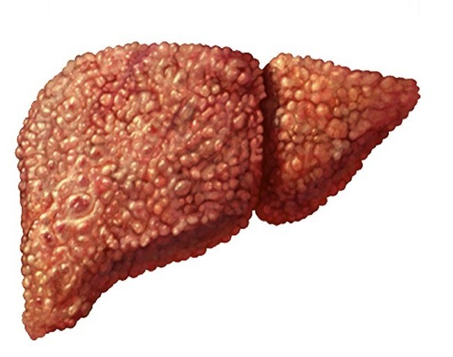 Complications of cirrhosis of the liver